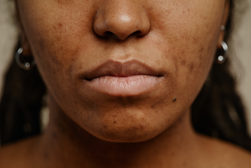 My Top Tips For Battling Hyperpigmentation! (Part 2)