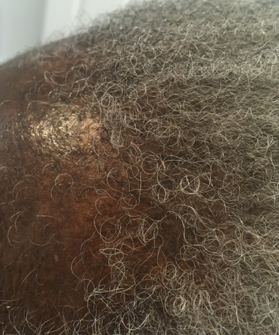 What Is Causing My Itchy Scalp?