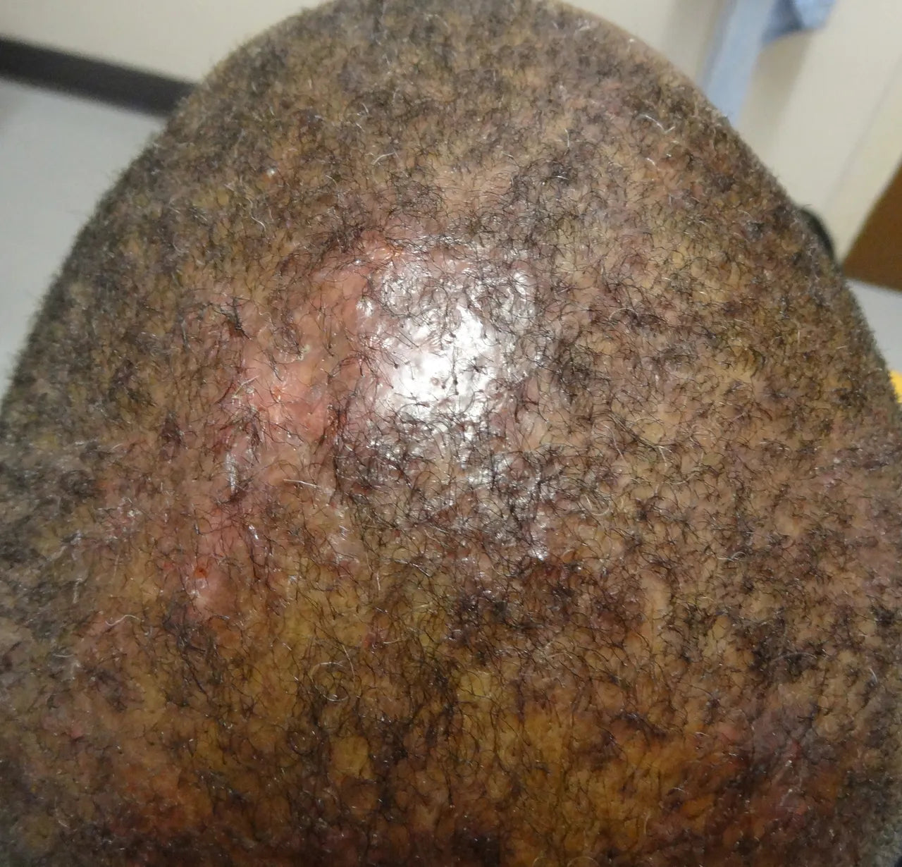 What Is Scarring Alopecia?